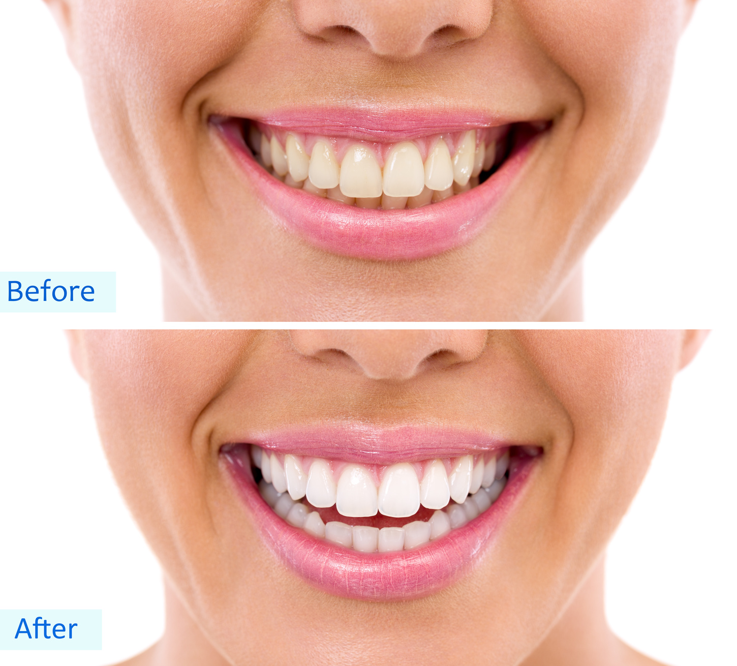  teeth-whitening